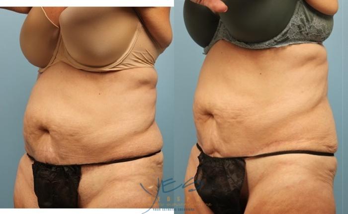 Before & After SculpSure® Case 254 View #2 View in Vancouver, BC
