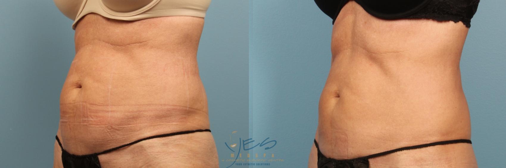 Before & After SculpSure® Case 335 Left Oblique View in Vancouver, BC