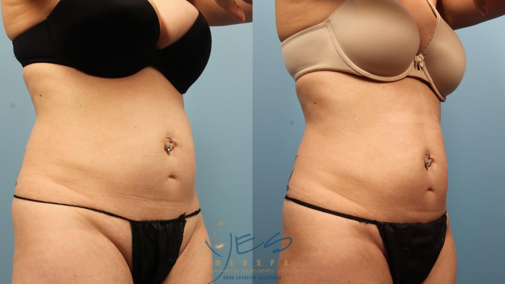 Before & After SculpSure® Case 337 Right Oblique View in Vancouver, BC