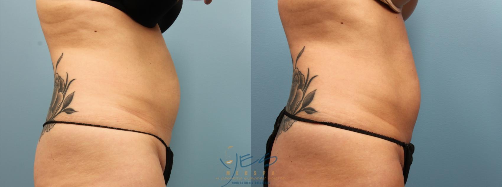 Before & After SculpSure® Case 337 Right Side View in Vancouver, BC