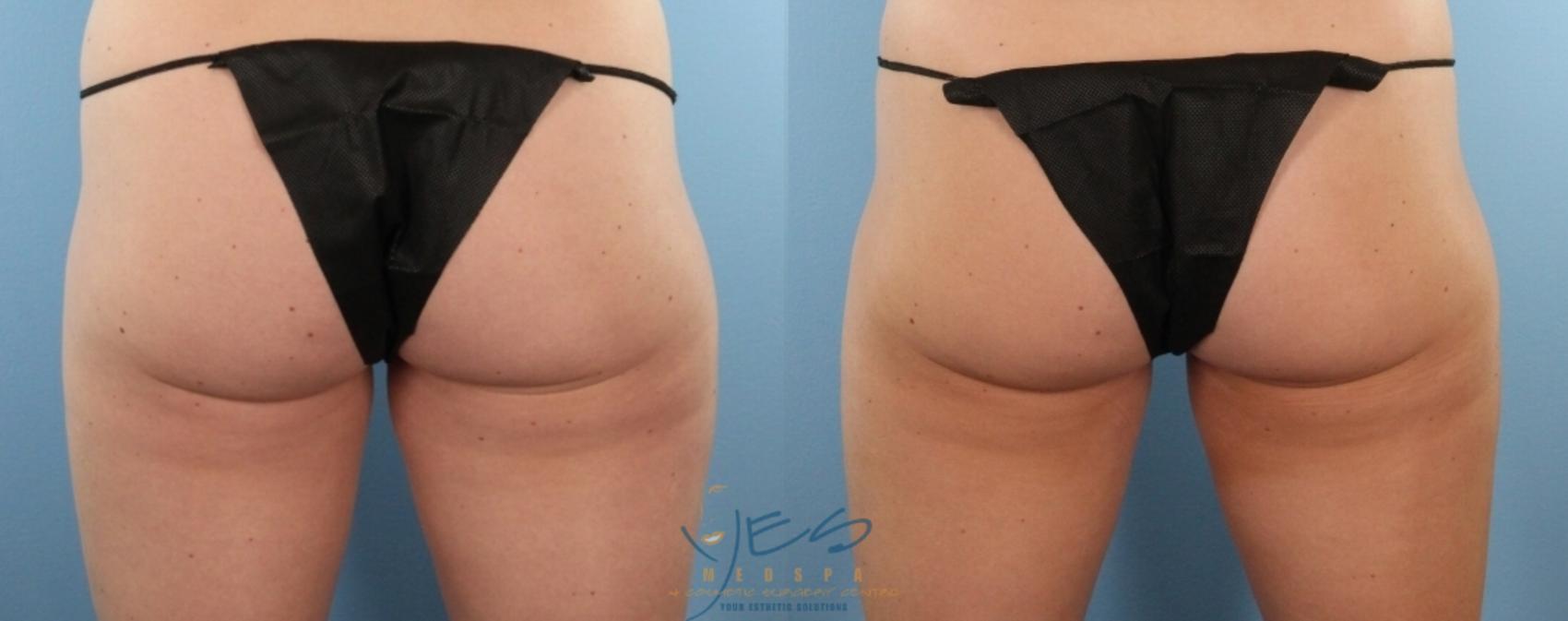 Before & After SculpSure® Case 418 Back View in Vancouver, BC