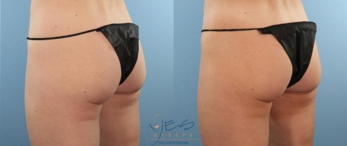 Before & After SculpSure® Case 418 Left Oblique View in Vancouver, BC