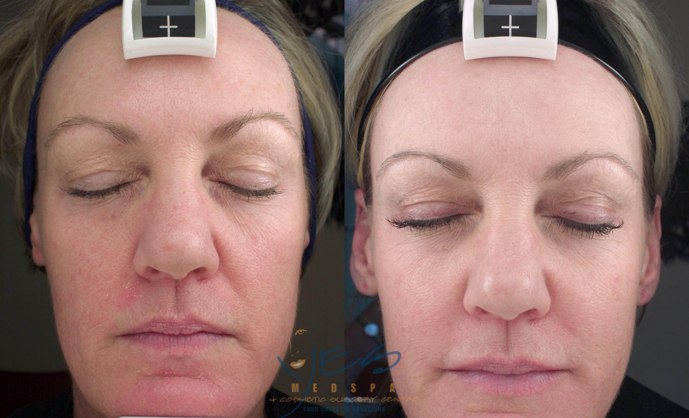 Before & After Skin Care Programs & Chemical Peels Case 116 View #1 View in Vancouver, BC