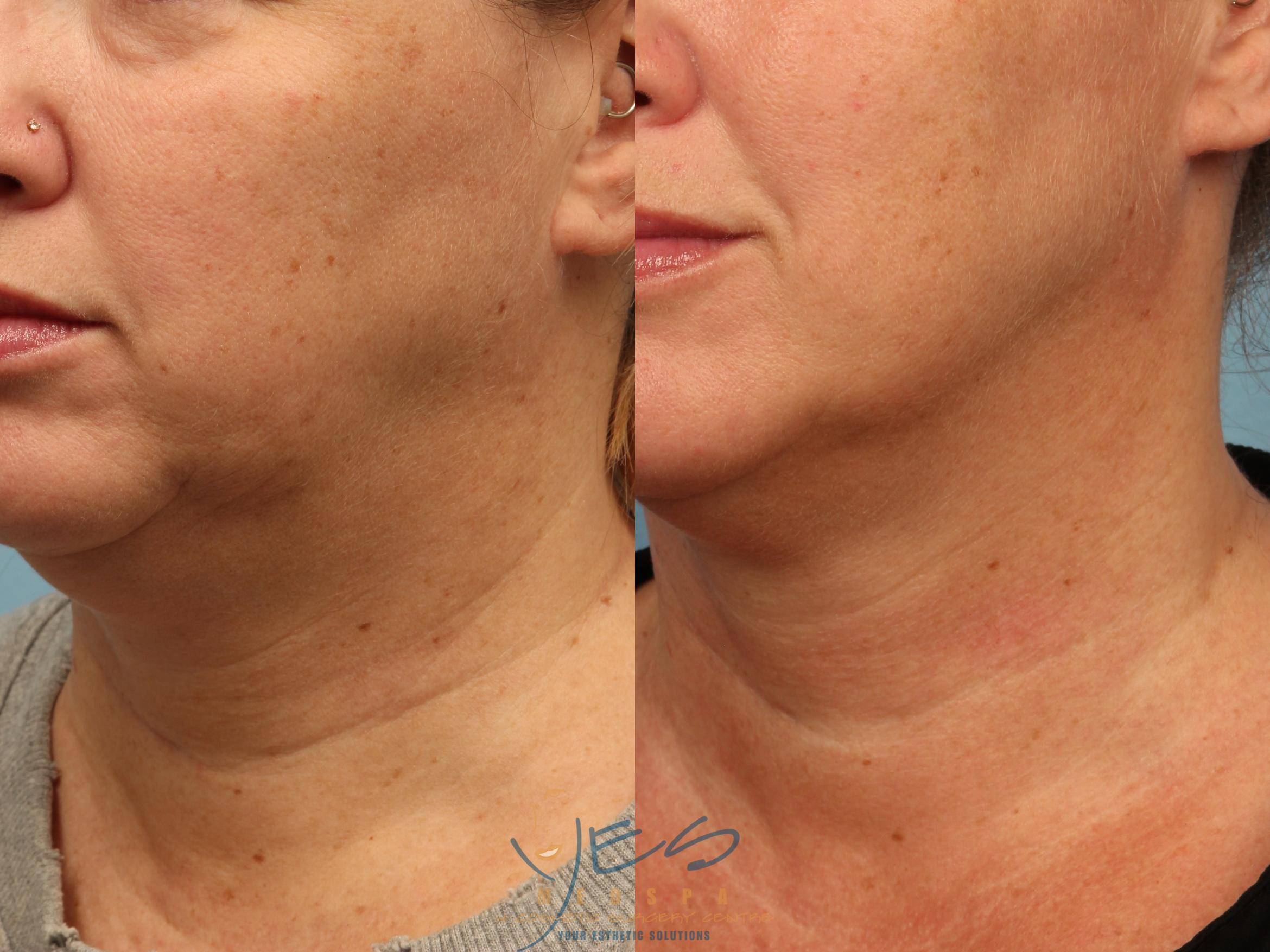 Before & After Skin Care Programs & Chemical Peels Case 342 Left Oblique View in Vancouver, BC