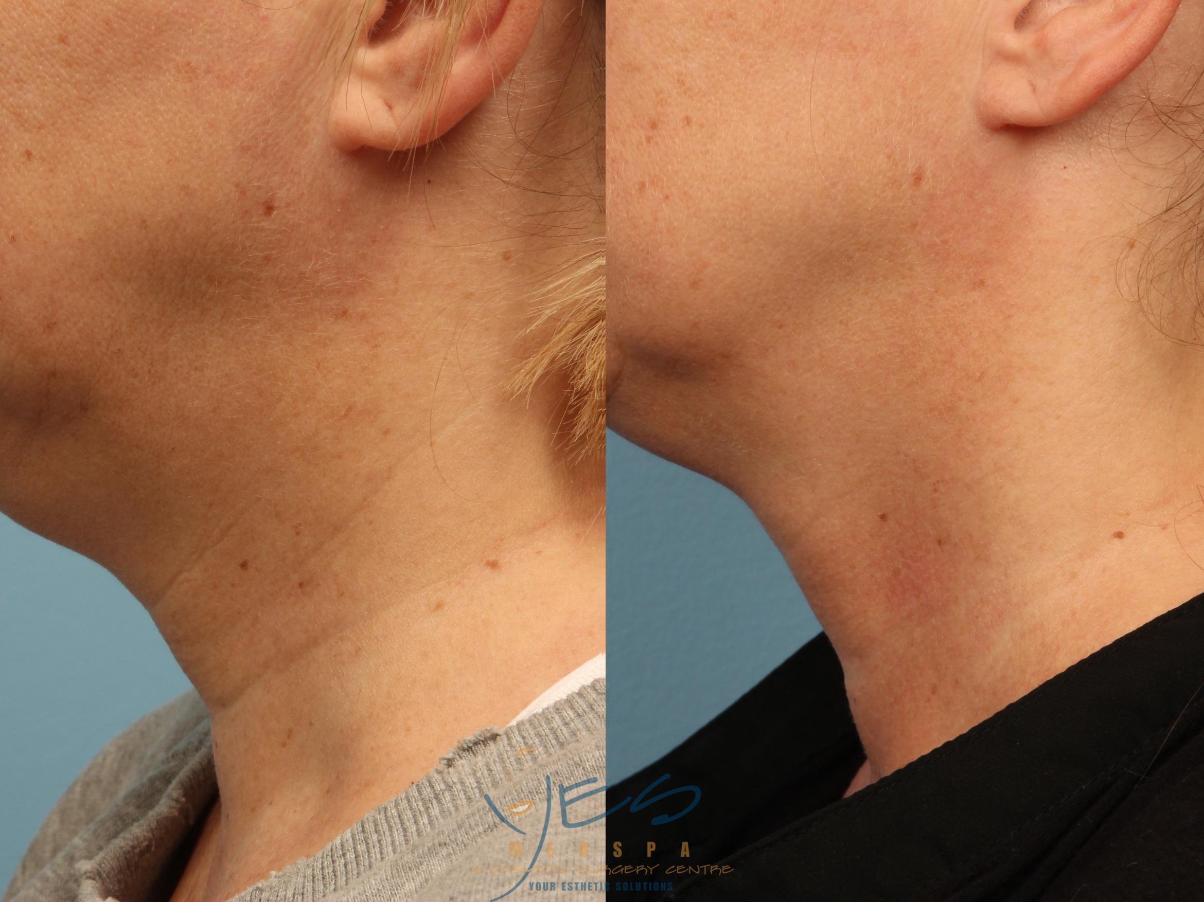 Before & After Skin Care Programs & Chemical Peels Case 342 Left Side View in Vancouver, BC