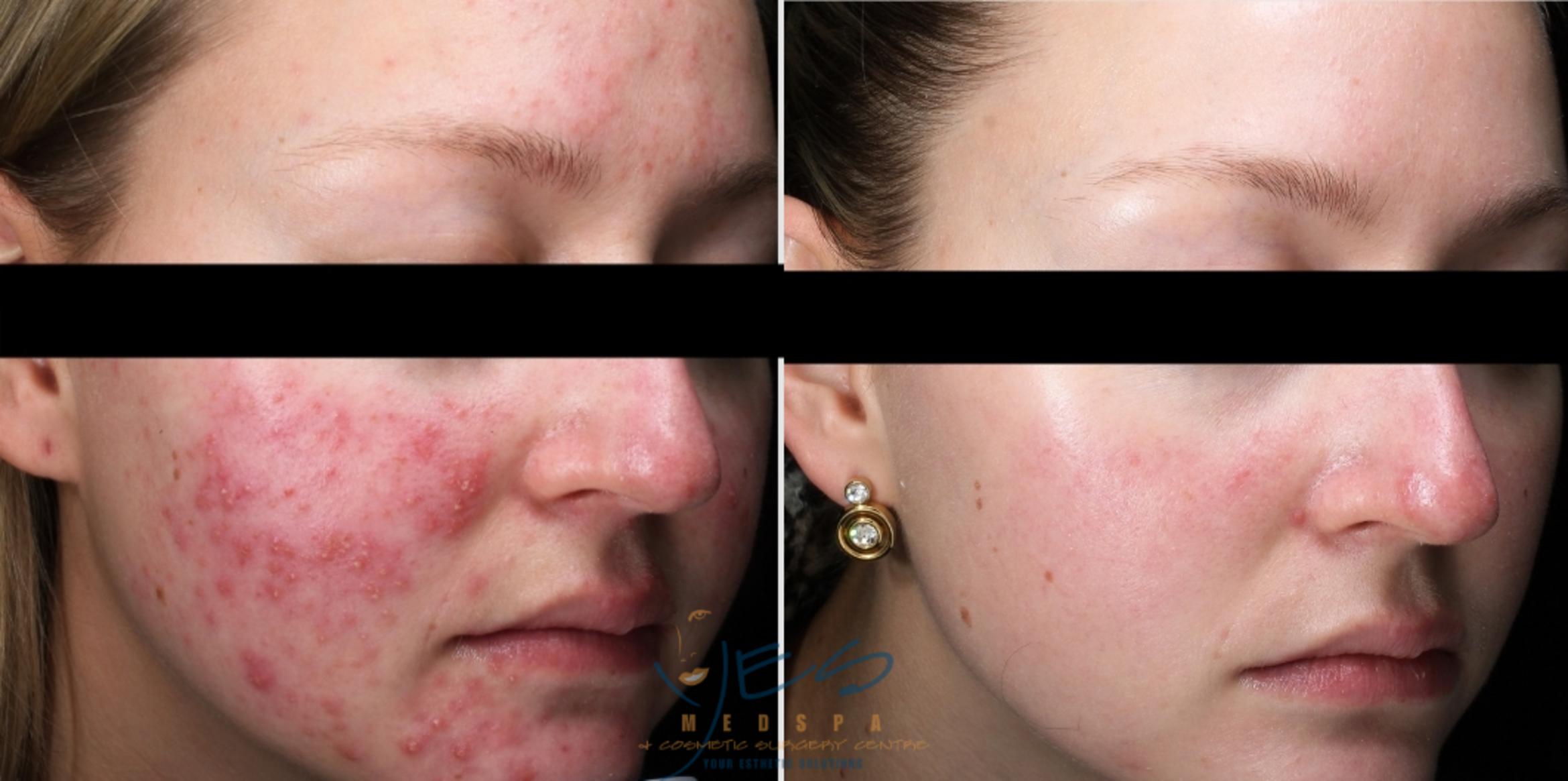 Before & After Skin Care Programs & Chemical Peels Case 347 Left Side View in Vancouver, BC