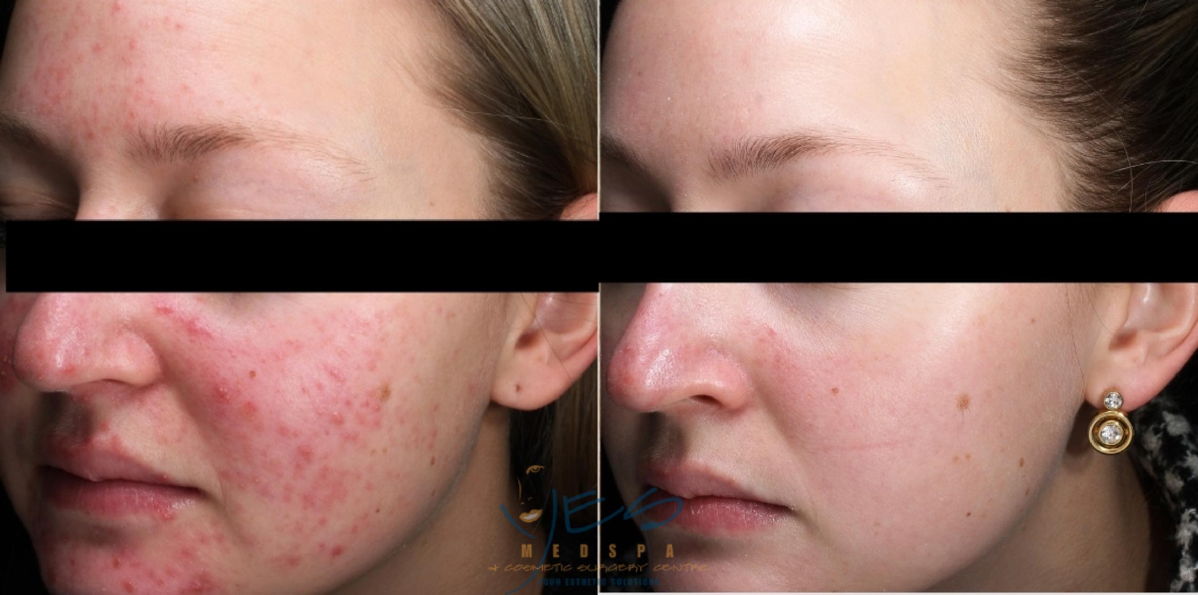 Before & After Skin Care Programs & Chemical Peels Case 347 Right Side View in Vancouver, BC