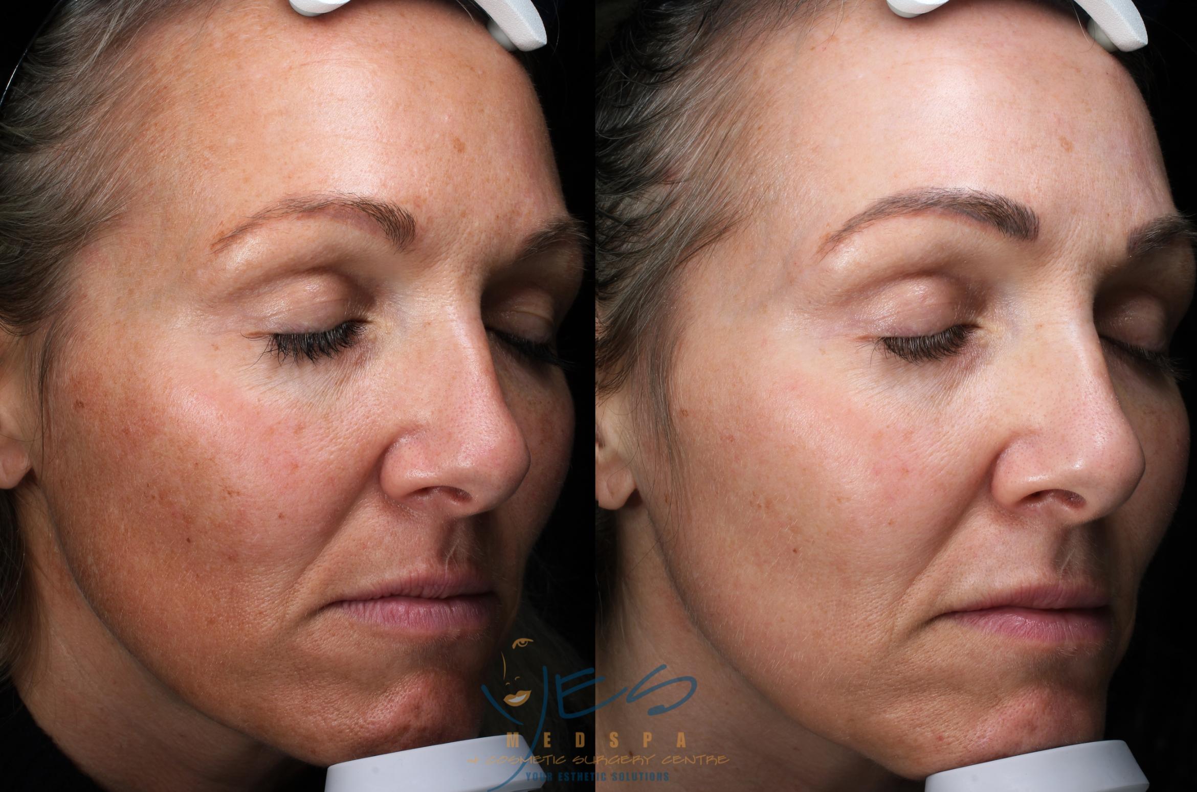 Before & After Skin Care Programs & Chemical Peels Case 370 Right Oblique View in Vancouver, BC