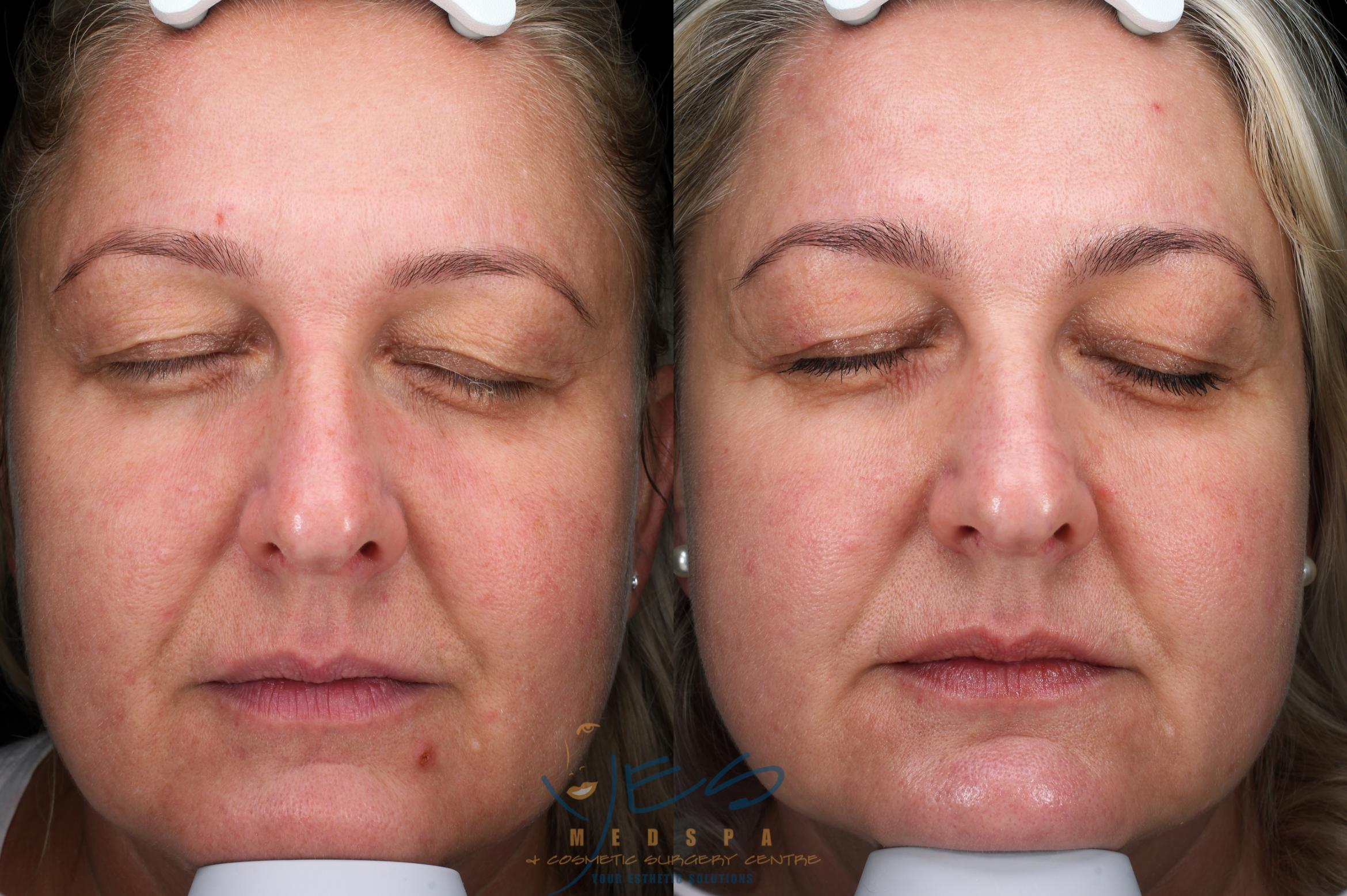 Before & After Skin Care Programs & Chemical Peels Case 387 Front View in Vancouver, BC