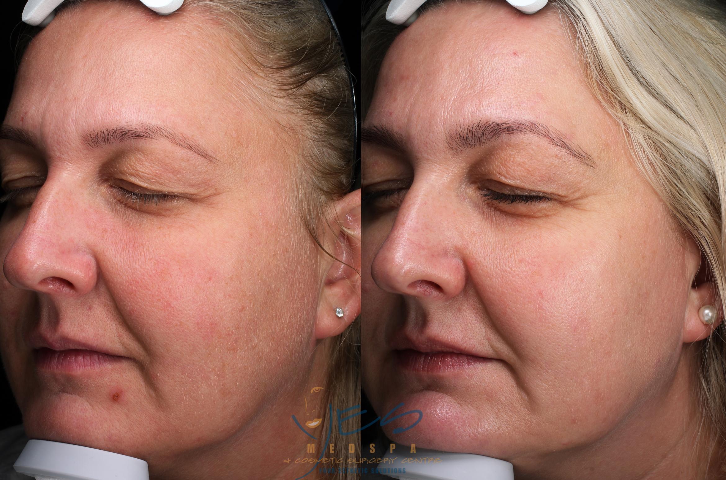 Before & After Skin Care Programs & Chemical Peels Case 387 Left Oblique View in Vancouver, BC