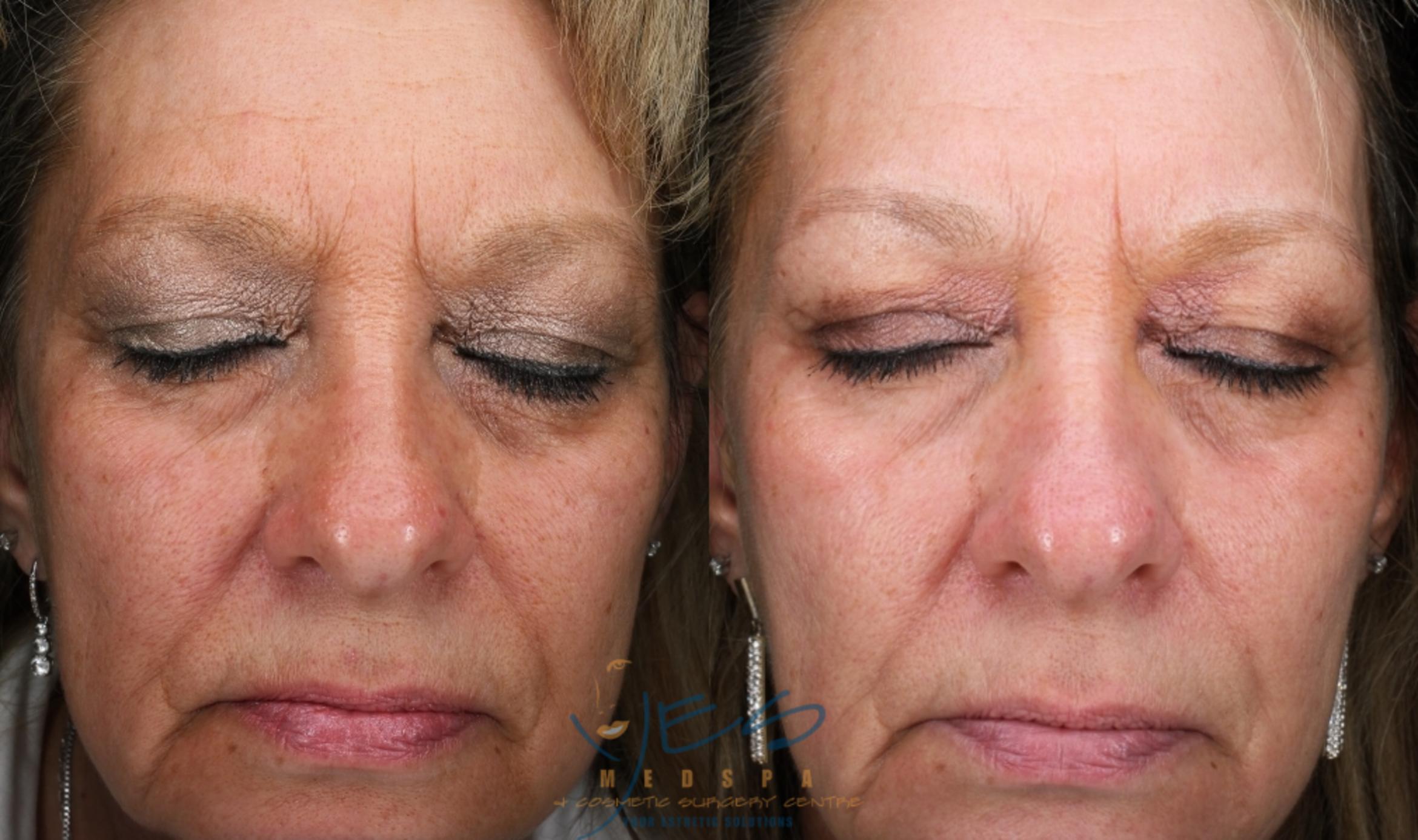 Before & After Skin Care Programs & Chemical Peels Case 388 Front View in Vancouver, BC
