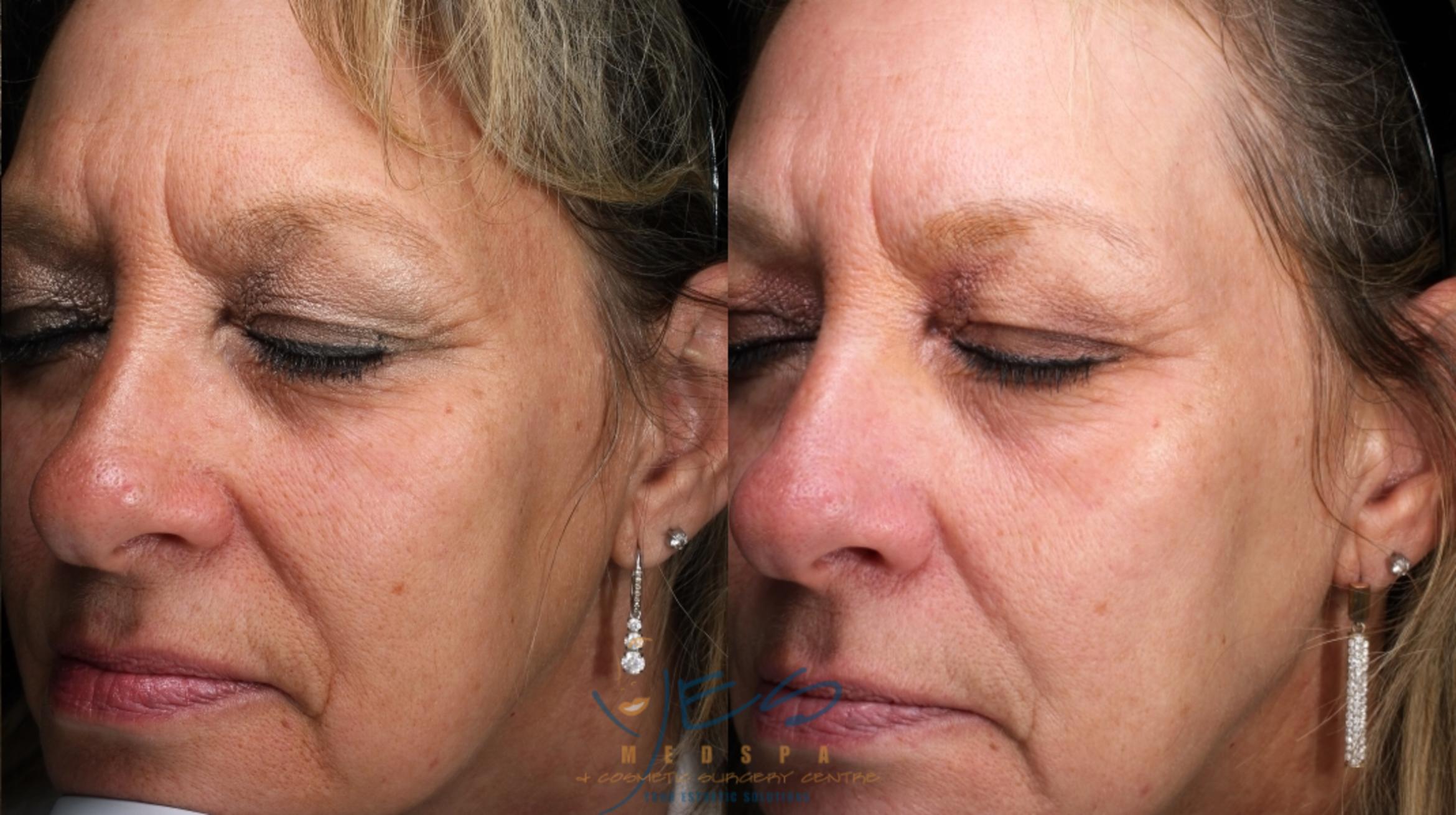 Before & After Skin Care Programs & Chemical Peels Case 388 Left Oblique View in Vancouver, BC