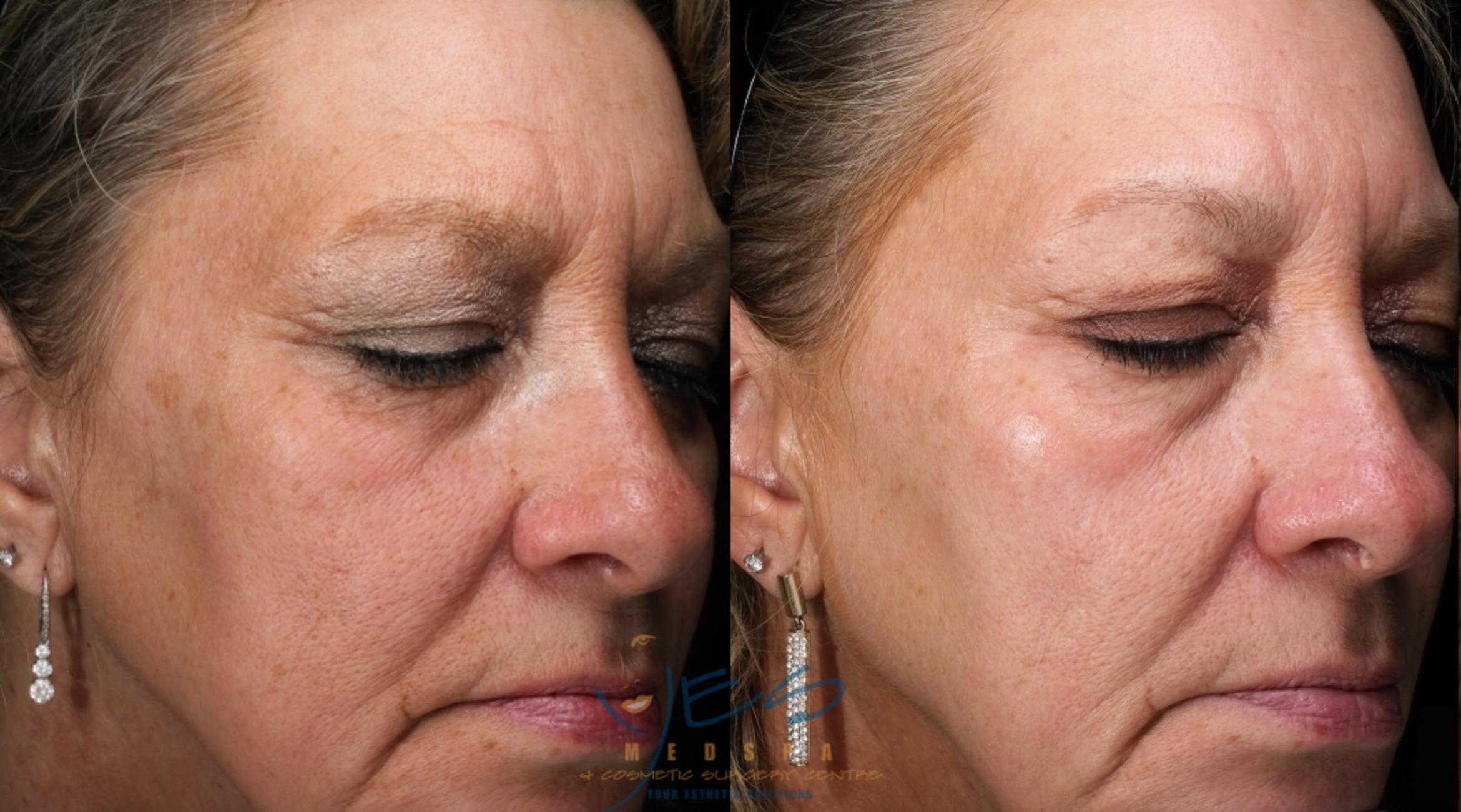 Before & After Skin Care Programs & Chemical Peels Case 388 Right Oblique View in Vancouver, BC