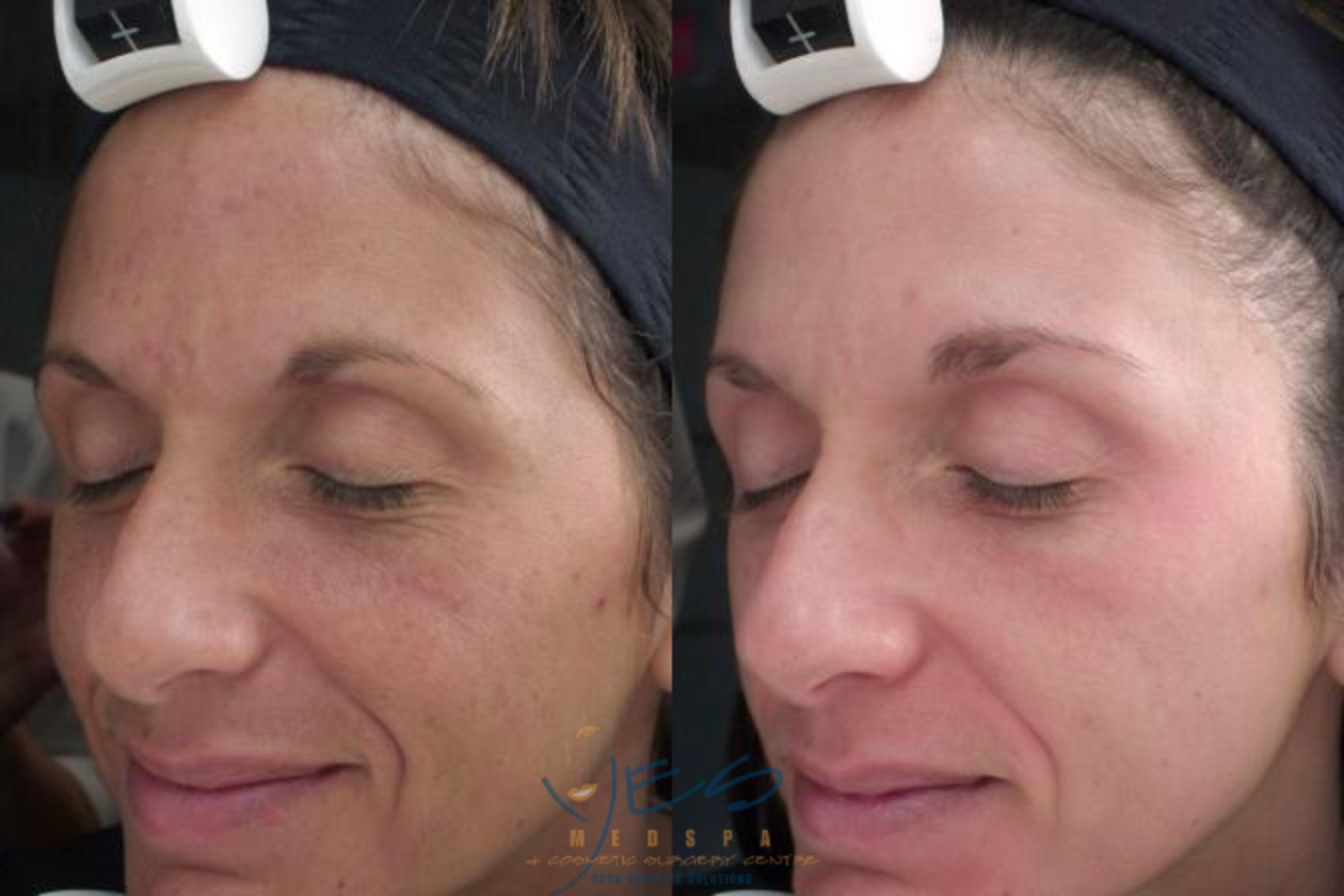 Before & After Skin Care Programs & Chemical Peels Case 111 View #1 View in Vancouver, BC