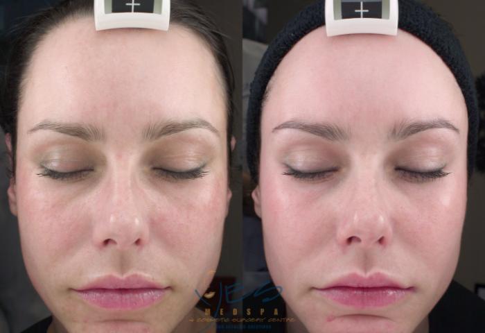 Before & After Skin Care Programs & Chemical Peels Case 117 View #1 View in Vancouver, BC