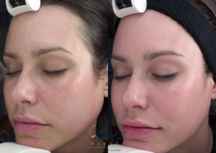 Before & After Skin Care Programs & Chemical Peels Case 117 View #2 View in Vancouver, BC