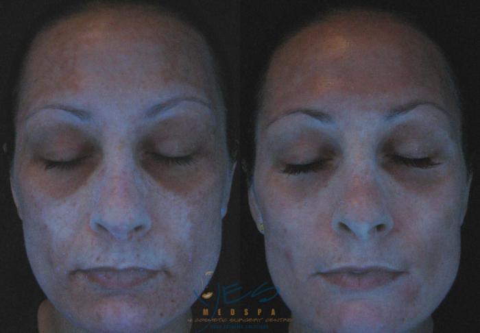 Before & After Skin Care Programs & Chemical Peels Case 121 View #1 View in Vancouver, BC