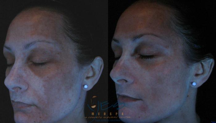 Before & After Skin Care Programs & Chemical Peels Case 121 View #2 View in Vancouver, BC