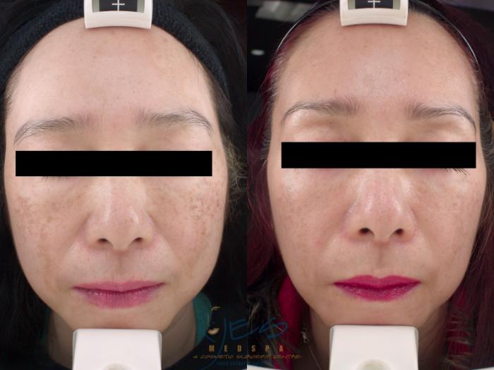Before & After Skin Care Programs & Chemical Peels Case 208 View #1 View in Vancouver, BC