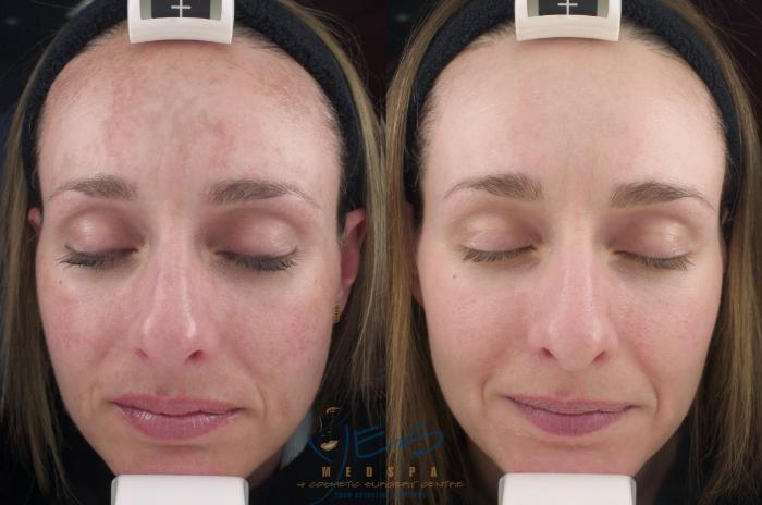 Before & After Skin Care Programs & Chemical Peels Case 209 View #1 View in Vancouver, BC