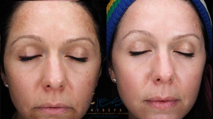 Before & After Skin Care Programs & Chemical Peels Case 210 Front View in Vancouver, BC