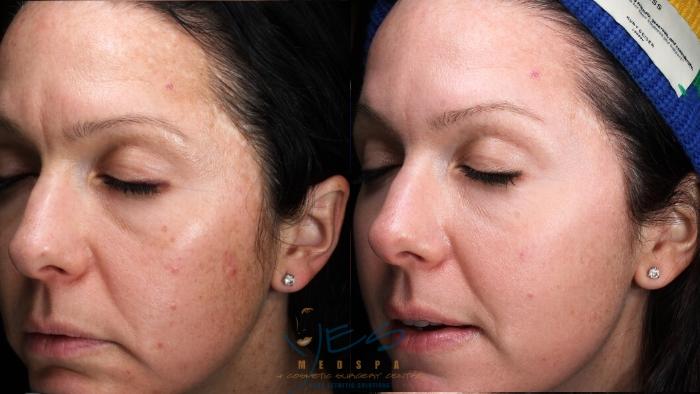 Before & After Skin Care Programs & Chemical Peels Case 210 Left Oblique View in Vancouver, BC