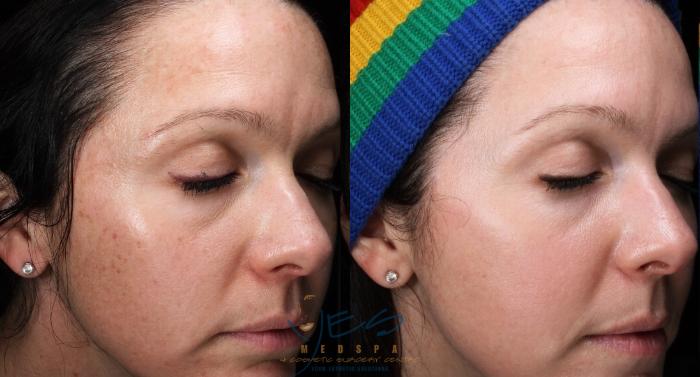 Before & After Skin Care Programs & Chemical Peels Case 210 Right Oblique View in Vancouver, BC