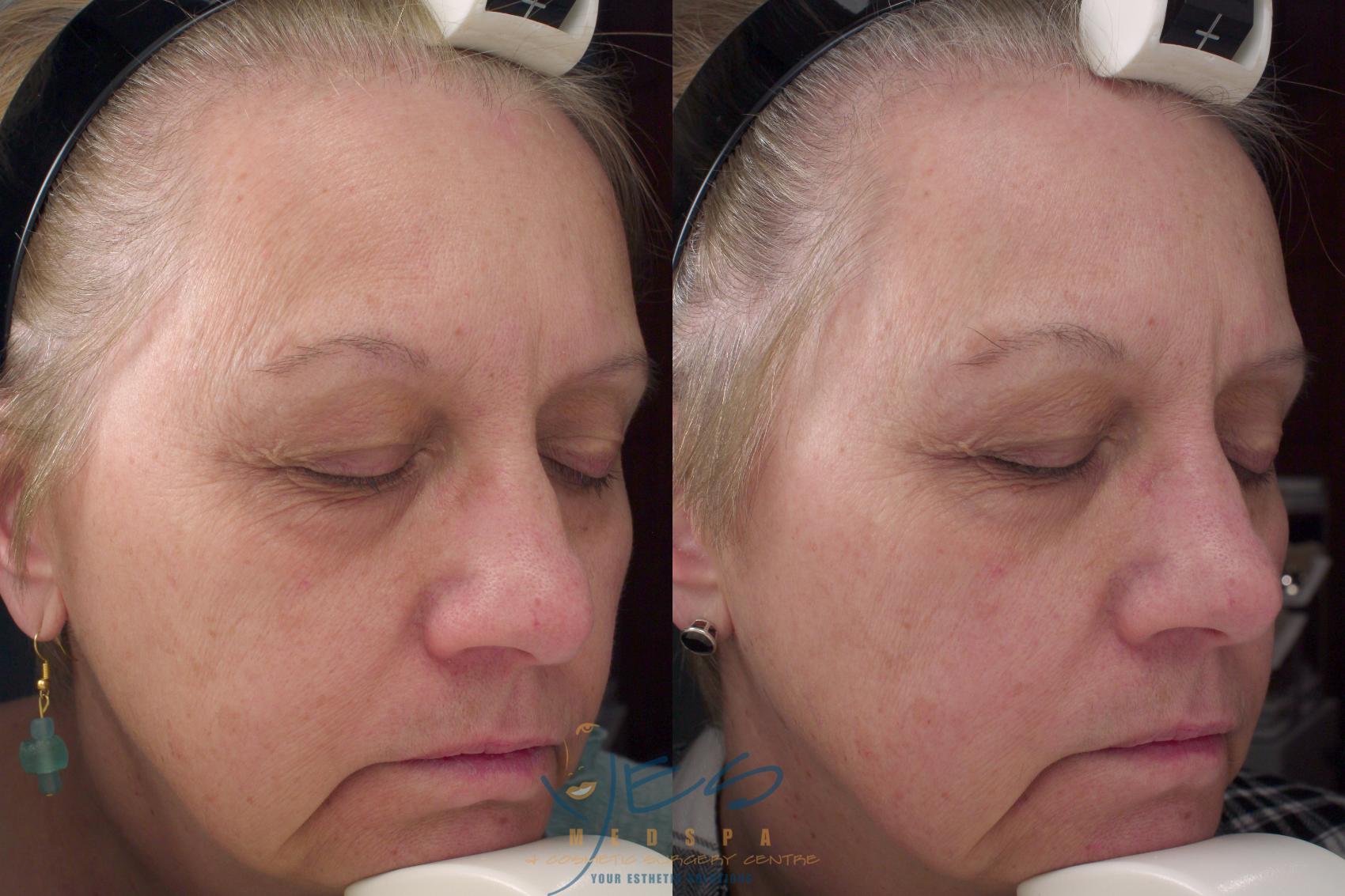 Before & After Skin Care Programs & Chemical Peels Case 271 Right Side View in Vancouver, BC