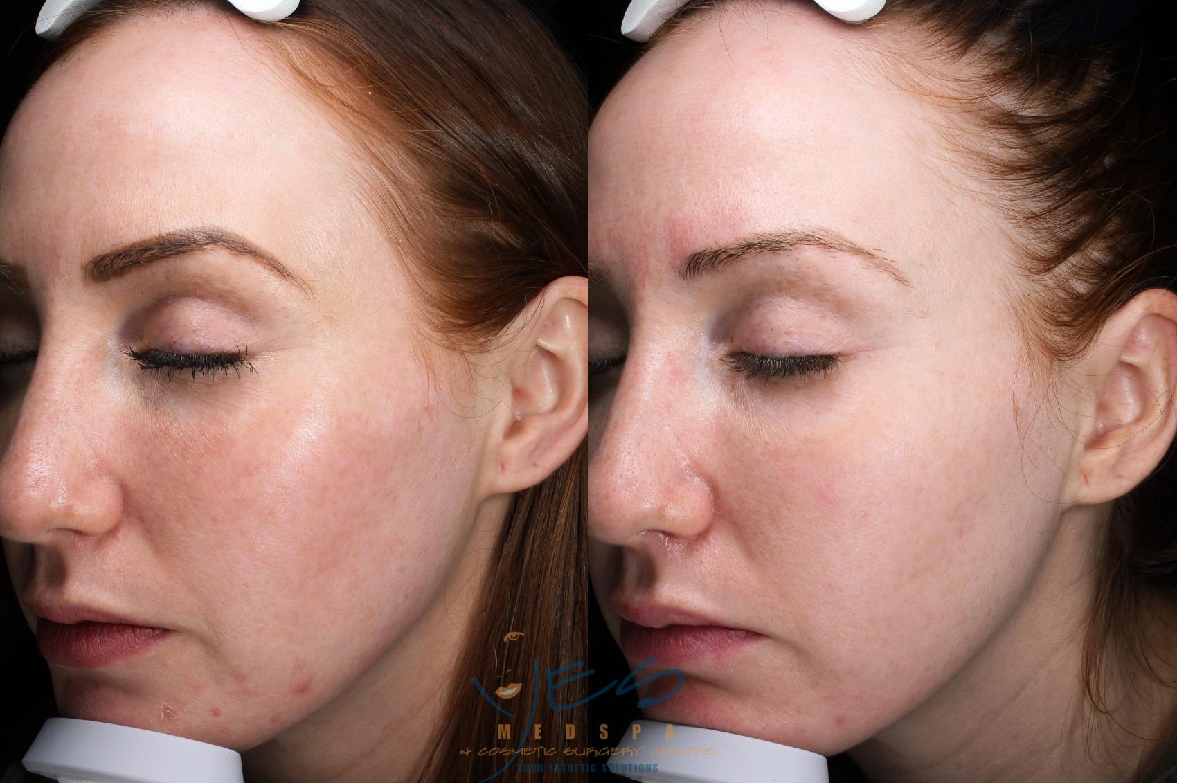 Before & After Skin Care Programs & Chemical Peels Case 341 Left Oblique View in Vancouver, BC
