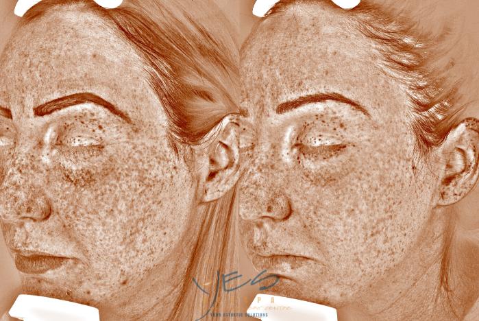 Before & After Skin Care Programs & Chemical Peels Case 341 Left Side View in Vancouver, BC