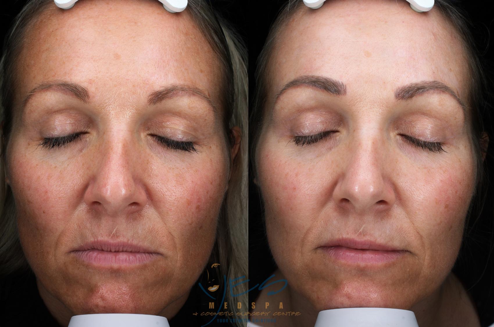 Before & After Skin Care Programs & Chemical Peels Case 370 Front View in Vancouver, BC