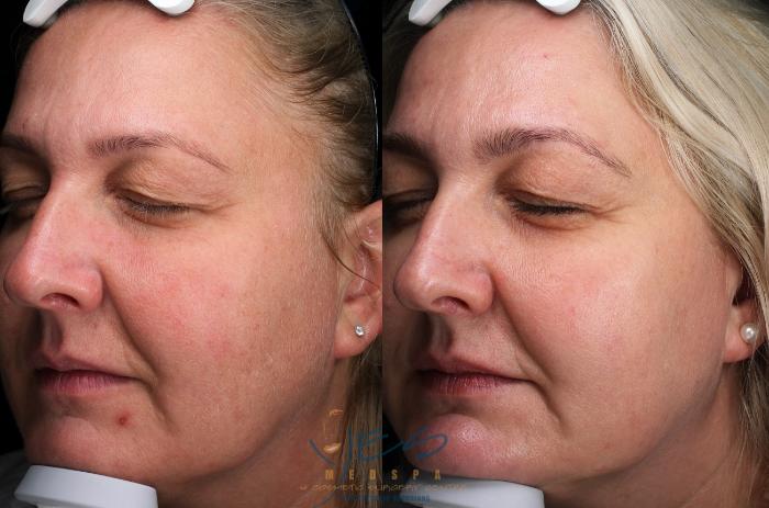 Before & After Skin Care Programs & Chemical Peels Case 387 Left Oblique View in Vancouver, BC