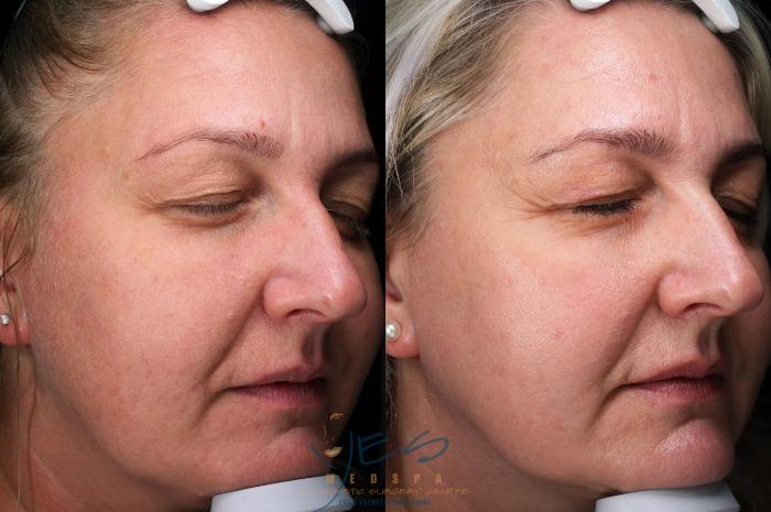 Before & After Skin Care Programs & Chemical Peels Case 387 Right Oblique View in Vancouver, BC