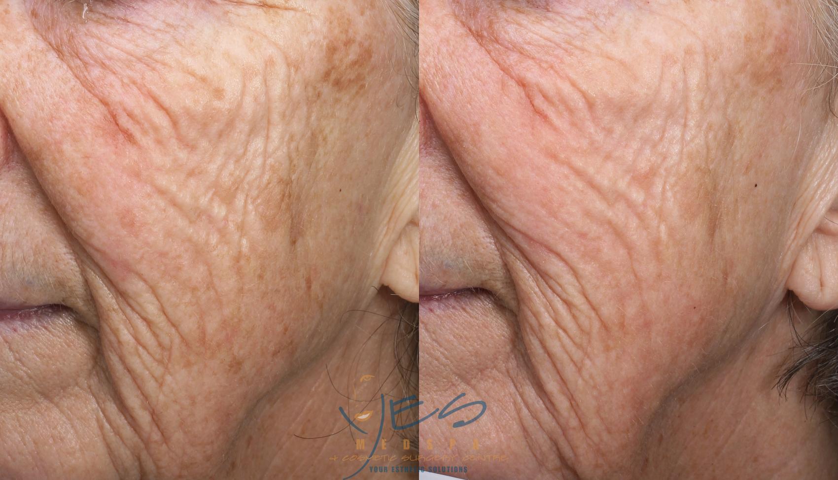 Before & After Skin Care Programs & Chemical Peels Case 389 Left Oblique View in Vancouver, BC