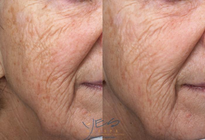 Before & After Skin Care Programs & Chemical Peels Case 389 Right Oblique View in Vancouver, BC