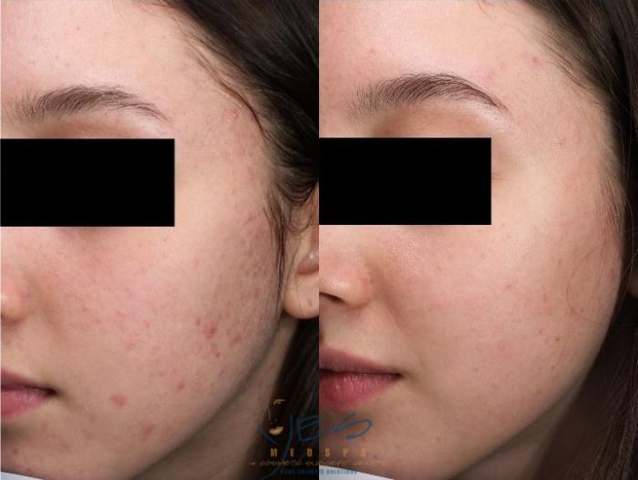 Before & After Skin Care Programs & Chemical Peels Case 390 Left Oblique View in Vancouver, BC