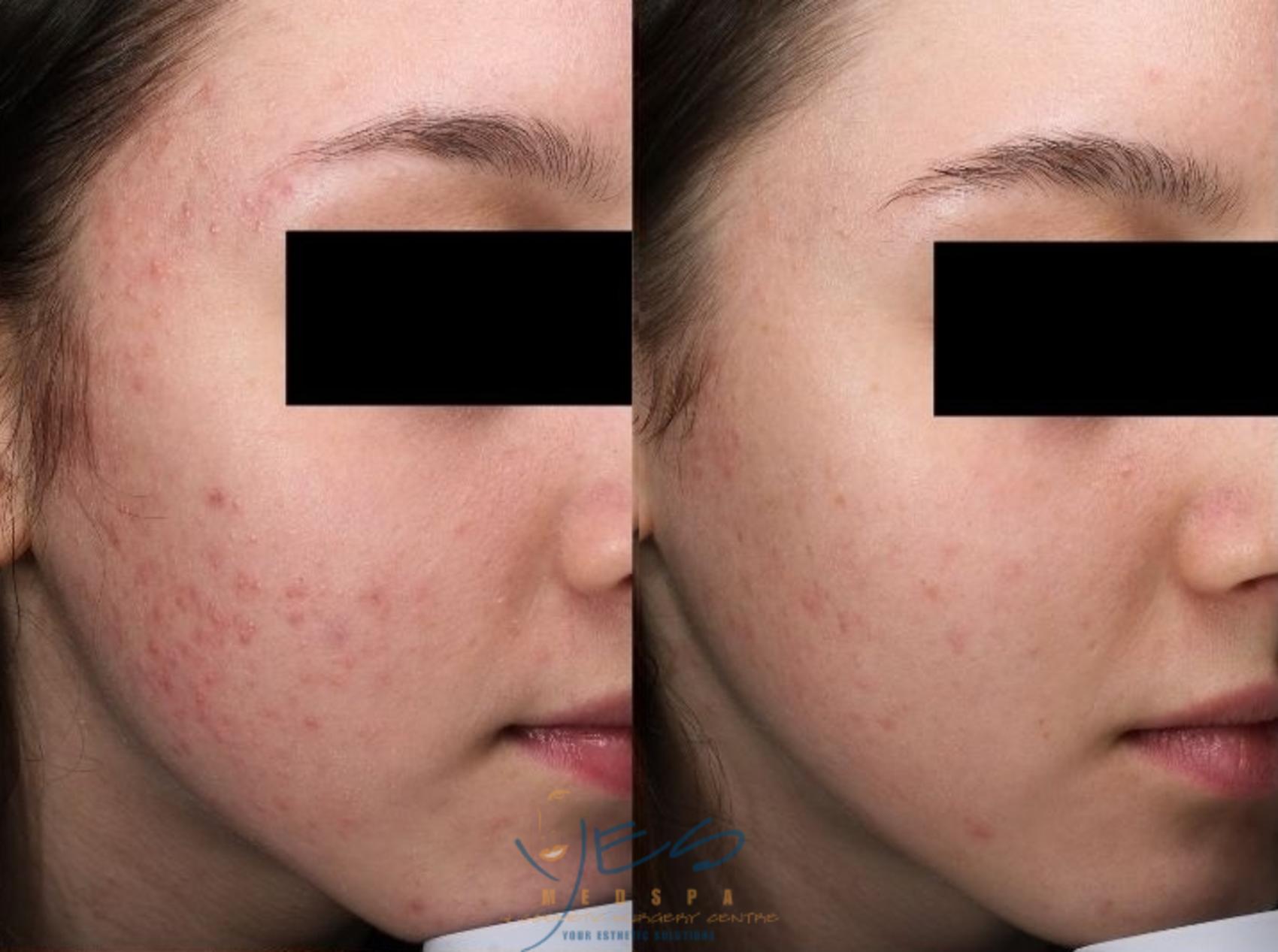 Before & After Skin Care Programs & Chemical Peels Case 390 Right Oblique View in Vancouver, BC