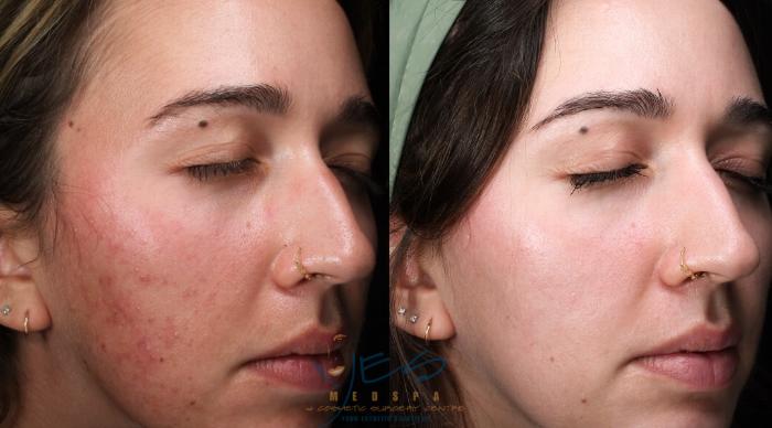 Before & After Skin Care Programs & Chemical Peels Case 391 Right Side View in Vancouver, BC