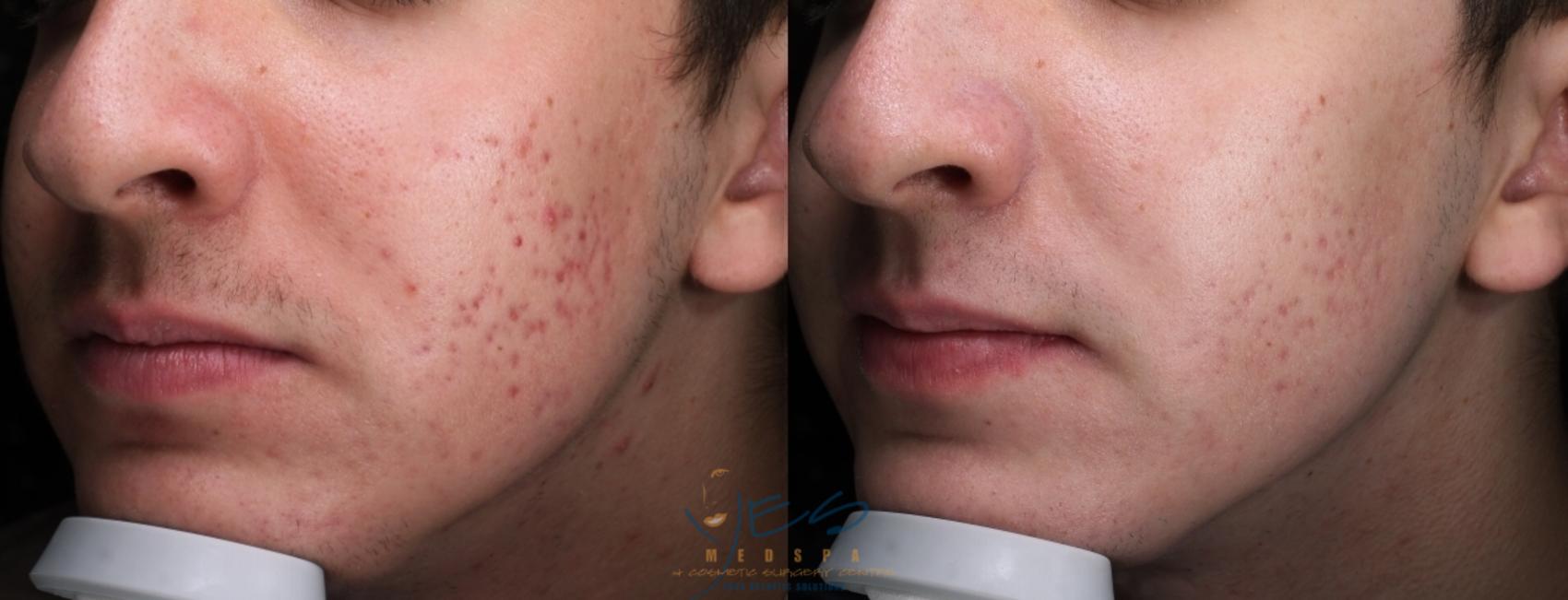 Before & After Skin Care Programs & Chemical Peels Case 395 Left Oblique View in Vancouver, BC