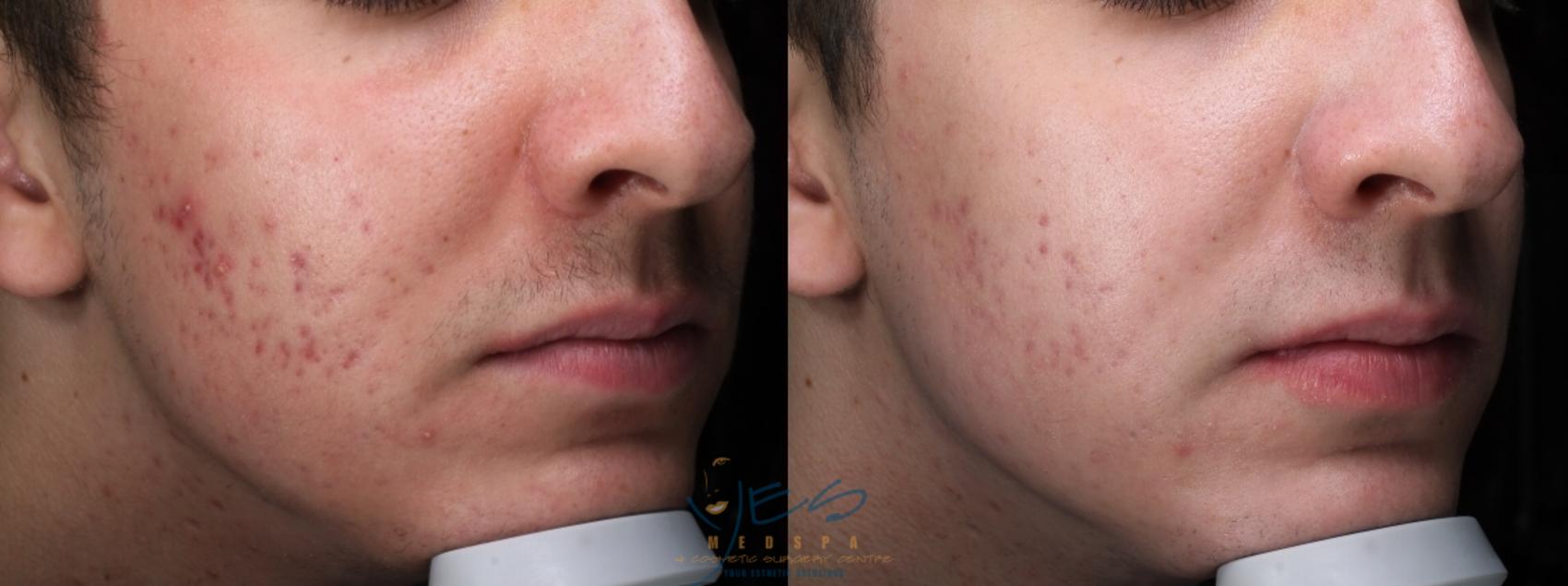 Before & After Skin Care Programs & Chemical Peels Case 395 Right Oblique View in Vancouver, BC