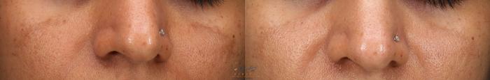 Before & After Skin Care Programs & Chemical Peels Case 396 Front View in Vancouver, BC