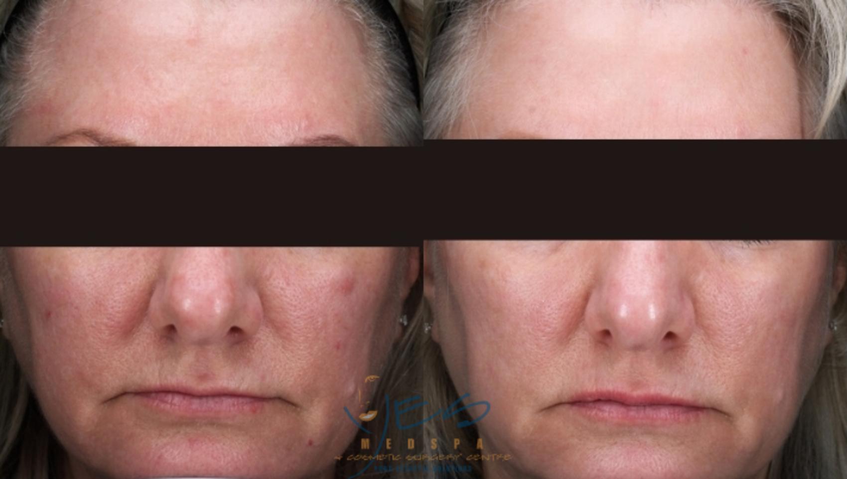 Before & After Photorejuvenation (IPL) Case 402 Front View in Vancouver, BC