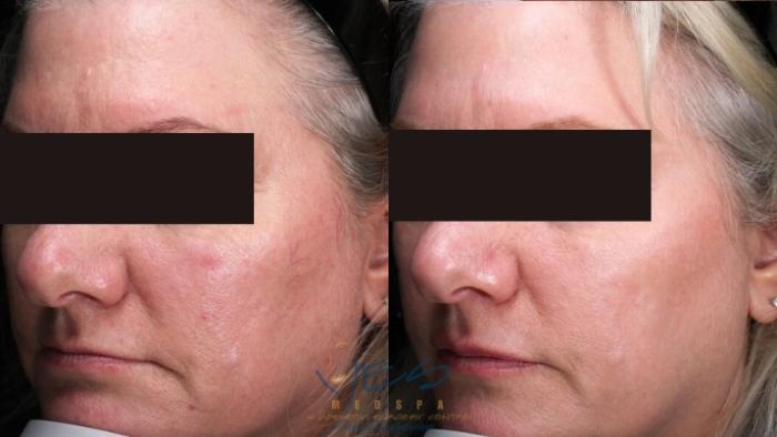 Before & After Skin Care Programs & Chemical Peels Case 402 Left Oblique View in Vancouver, BC