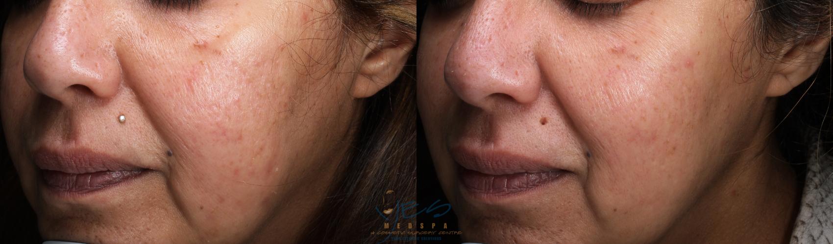 Before & After Skin Care Programs & Chemical Peels Case 403 Left Oblique View in Vancouver, BC