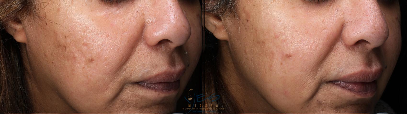Before & After Skin Care Programs & Chemical Peels Case 403 Right Side View in Vancouver, BC