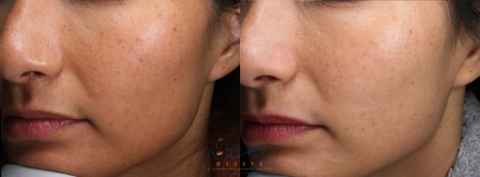 Before & After Skin Care Programs & Chemical Peels Case 404 Left Oblique View in Vancouver, BC