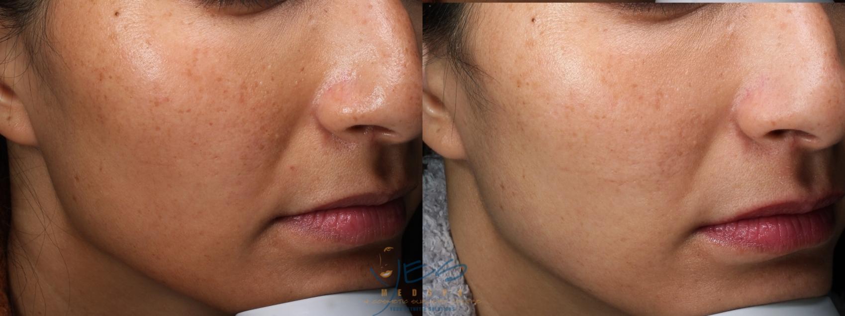 Before & After Skin Care Programs & Chemical Peels Case 404 Right Side View in Vancouver, BC