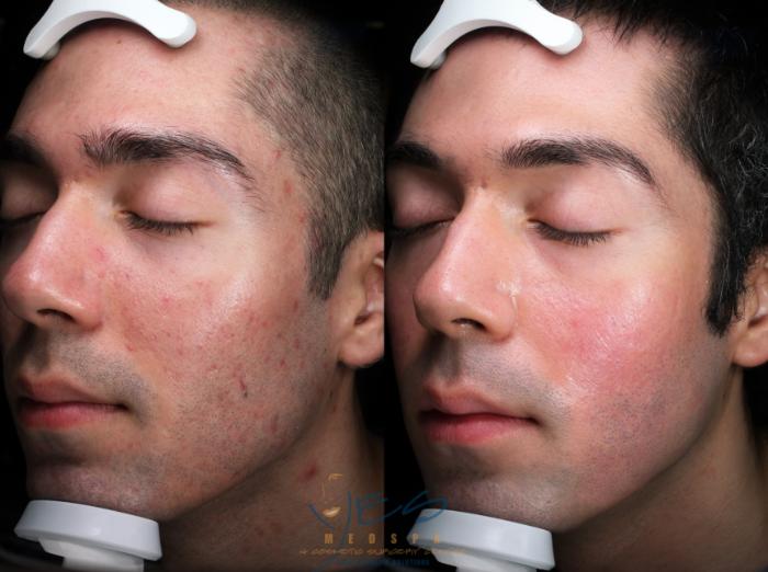 Before & After Skin Care Programs & Chemical Peels Case 409 Left Oblique View in Vancouver, BC