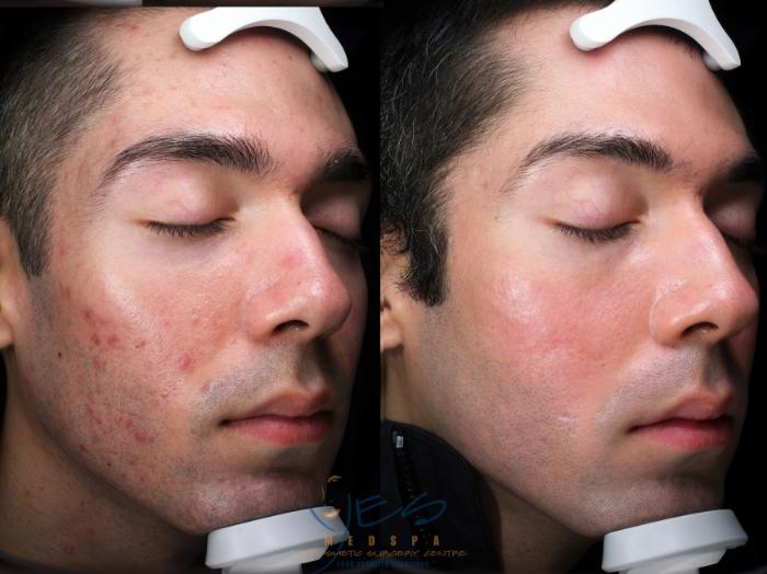 Before & After Skin Care Programs & Chemical Peels Case 409 Right Oblique View in Vancouver, BC