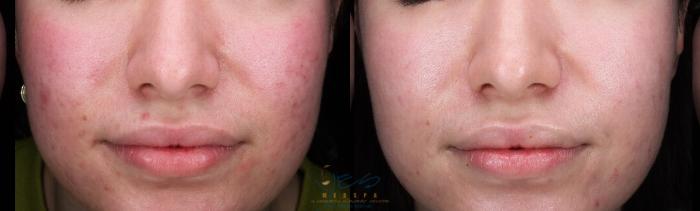 Before & After Skin Care Programs & Chemical Peels Case 417 Front View in Vancouver, BC